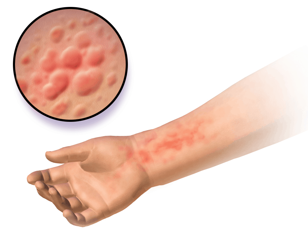 Coeliac Disease Symptoms